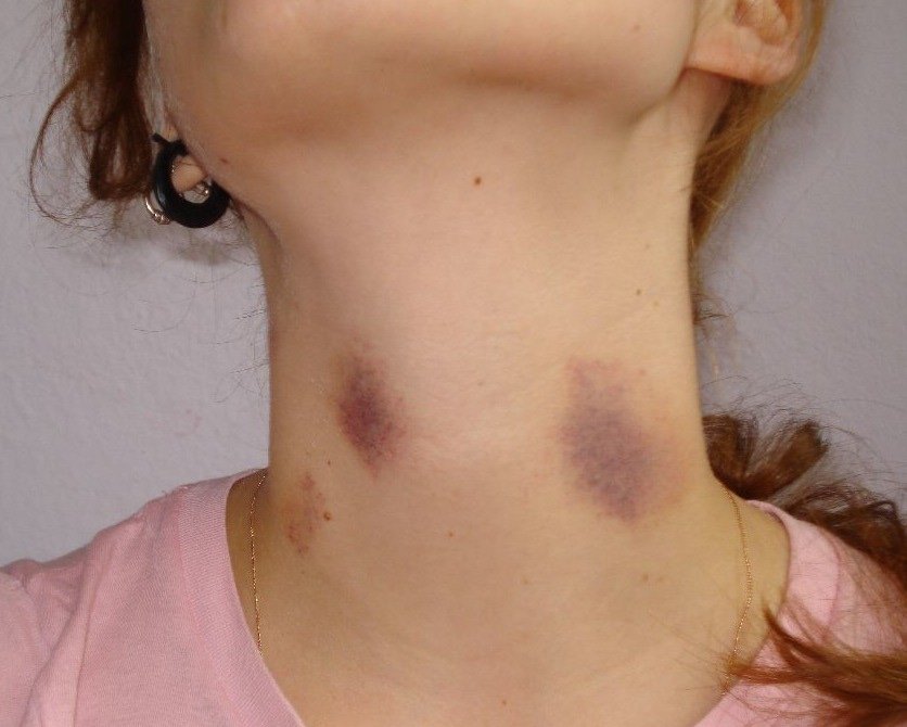 how long does a hickey last